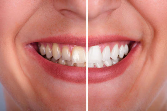 Teeth Whitening